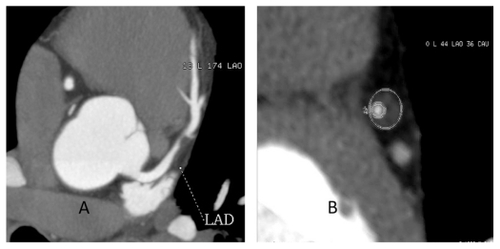 Figure 1 Dual-source computed tomography of a 55-year-old male with typical angina. A) Maximum intensity projections of left anterior descending coronary artery showing significant stenosis due to soft plaque. B) Corresponding cross-section of the plaque in A and inner circle showing luminal cross-sectional area, and external circle showing external elastic membrane cross-sectional area.