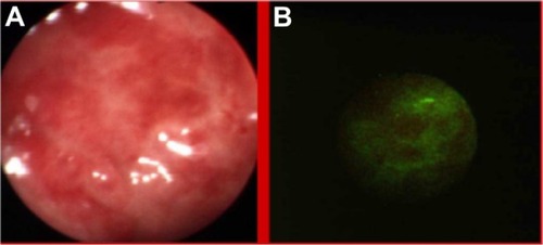 Figure 2 Ulcerative colitis in white light colonoscopy (A) and autofluorescence (B) imaging.