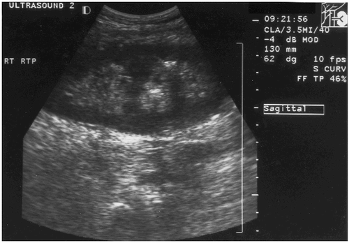 Figure 5. Ultrasound performed after passage of stones showing resolution of hydronephrosis and fewer stones.