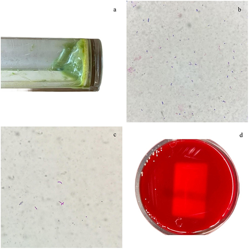Figure 1 (a) Green watery stool specimen from the child; (b) Gram-positive slender bacilli with a non-uniform color fecal smear(Gram staining, 1000×); (c) Acid-fast staining portion weak-positive fecal smear(Weak acid-fast staining, 1000×); (d) Colony morphology after 48h incubation by fecal on Columbia blood plate.