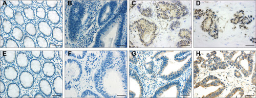 Figure 1 Immunohistochemical staining of RBP-Jκ and CXCL11 in colon cancer tissues and paratumorous tissues. (A–D) RBP-Jκ staining. (A) Paratumorous tissue. (B) Negative expression in colon cancer tissues. (C) Low expression in colon cancer tissues. (D) High expression in colon cancer tissues. (E–H) CXCL11 staining. (E) Paratumorous tissue. (F) Negative expression in colon cancer tissues. (G) Low expression in colon cancer tissues. (H) High expression in colon cancer tissues. Scale bar, 50μm.