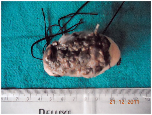 Figure 3. Hemiglossectomy specimen.