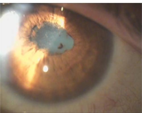 Figure 5 Recurrent nongranulomatous iridocyclitis with posterior synechiae in the left eye of a patient working in a furs elaboration industry, with positive serology for B. quintana (patient 9 in Tables 2 and 3).