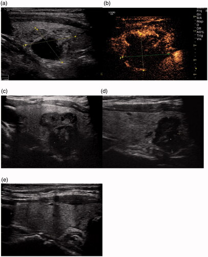 Figure 2. MWA treatment of a 59-year old man with a left thyroid predominantly cyst nodule. (A) Two-dimensional ultrasonic image of the thyroid nodule. (B) The contrast enhanced ultrasound image of the thyroid nodule after treatment. (C) Two-dimensional ultrasonic image of the nodule one month after the ablation. (D) Two-dimensional ultrasonic image of the nodule twelve months after the ablation. (E) Two-dimensional ultrasonic image of the nodule twenty-four months after the ablation.
