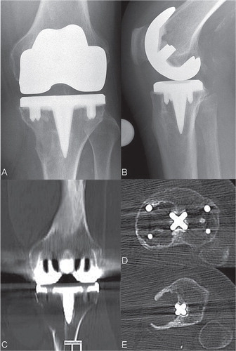 Figure 2. Anterioposterior and lateral radiograph and CT scans showing osteolysis of the distal left femur and the proximal tibia 4 years after implantation of a cemented TKA.
