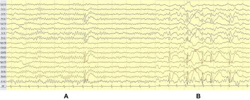 Figure 2 Case 1 - awake (A) vs NREM (B) (bipolar montage).