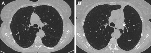 Figure 1 High-resolution computed tomography prior to (A) and after (B) endoscopic valve placement leading to a complete atelectasis in the left upper lobe. The arrow shows an implanted endobronchial valve.