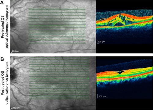 Figure 3 Represents the spectral domain optical coherence tomography of the left eye at pre-treatment and post-treatment phases.