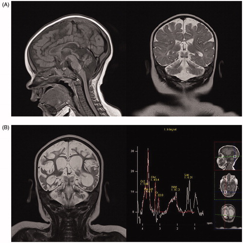 Figure 1. (A) First MRI scan, age 5 months. Sagittal T1-weighted and coronal T2-weighted imaging showing diffuse white matter reduction, marked cerebral and cerebellar atrophy, corpus callosum thinning, and brainstem hypoplasia. (B) MRI scan, age 9 months. Coronal T2-weighted imaging showing marked progression of cerebral and cerebellar atrophy and ventriculomegaly (dominantly left occipital ventricle) due to diffuse white matter necrosis, while MRI spectroscopy showed markedly increased myoinositol peak, increased lactate peak, and reduced N-acetyl aspartate peak.