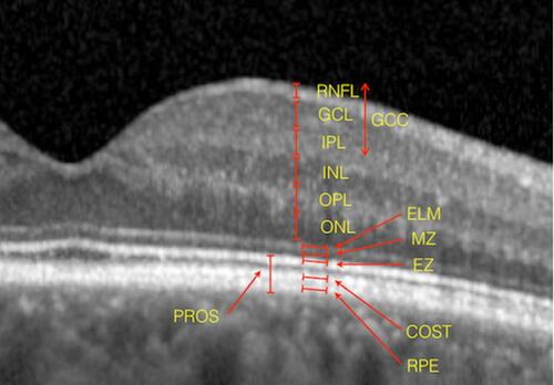 Figure 4 Spectral-domain optical coherence tomography layering of a normal eye. From inner to outer: retinal nerve fiber layer (RNFL), ganglion cell layer (GCL), inner plexiform layer (IPL), outer nuclear layer (INL), outer plexiform layer (OPL), outer nuclear layer (ONL), external limiting membrane (ELM, hyperreflective), myoid zone (MZ, hyporeflective), ellipsoid zone (EZ, hyperreflective), cone outer segment tips layer (COST, hyperreflective, otherwise known as “interdigitation zone”), retinal pigment epithelium (RPE, hyperreflective). The ganglion cell complex layer (GCC) encompasses together the RNFL, GCL and IPL. The photoreceptor outer segment (PROS) represents the distance form the ELM to the RPE.