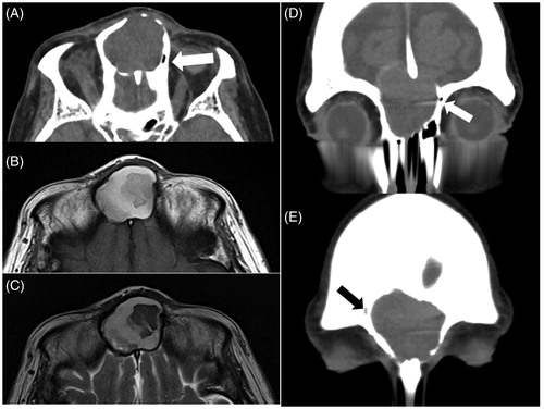 Figure 1. Axial CT showed a mucocele on the center of the frontal lesion, thinning the rear bony wall of the frontal table in the midline (A). MRI showed that the frontal mass had heterogeneous moderate to high intensity on T1-weighted and moderate to low intensity on T2-weighted imaging (B, C). The remnants of the bilateral small frontal sinuses were located on the both sides of the cyst, on the right side with air (A, D: white arrows) and on the left side with soft tissue (E: black arrow).