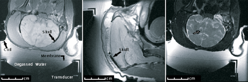 Figure 2. MRI slices, showing (left, center) the ultrasound transducer coupled via a water interface to a Rhesus monkey that has undergone a craniotomy before replacement of the skin, and an ultrasound-induced lesion (right) is enhanced following sonication (graphic courtesy of N. McDannold).
