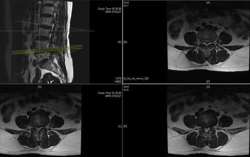 Figure 6 Postoperative MRI showed that the spinal canal was widened and the herniated part of the intervertebral disc vanished.