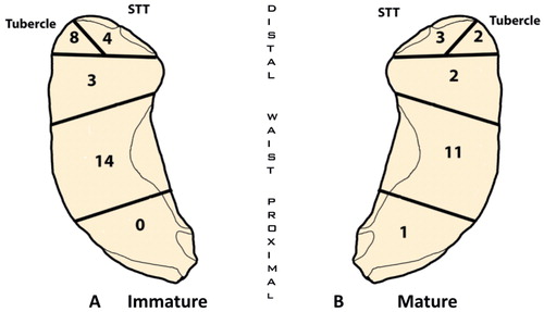 Figure 3. Anatomical distribution of scaphoid fractures.A. Immature wrists with open epiphyses (open epiphyses of first metacarpal).B. Mature wrists with closed epiphyses.