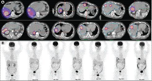 Figure 2. High-dose rate interstitial brachytherapy plans of the 15 lesions treated (A) and the maximum intensity projectionimages of 18F-18F-FDG PET-CT performed serially from April 2019 till December 2020 (B).