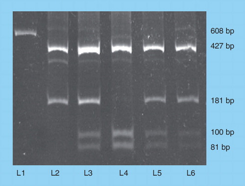 Figure 2. HindIII PCR-restriction fragment length polymorphism products on PAGE: L1 undigested sample, L2 case (-), L3 informative mother (+/-), L4 father (+), L5 (+/-) carrier sister L6 (+/-), carrier maternal aunt.