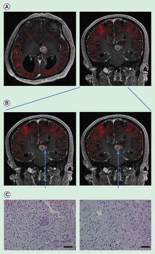 Figure 1. Restriction spectrum imaging (RSI)-guided selection of biopsy sites. (A) RSI signal imposed onto conventional MR imaging. Red color indicates regions of increased cellularity. Expectedly, the cortex of the cerebrum exhibits increased RSI signal. There is an increased RSI signal on the lateral edge of the tumor mass. (B) Biopsy of a region of tumor with increased RSI signal and another adjacent region without increased RSI signal. (C) Pathologic specimens secured from respective regions. The region of increased RSI signal revealed increased cellularity as well as increased microvascular proliferation. The region without increased RSI signal showed moderate cellularity. Both slides were taken at 20×. Bar = 50 μm. The specimens were stained by H&E.