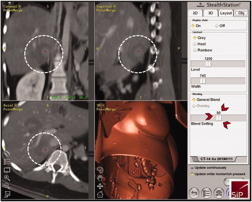 Figure 3. Three-dimensional views of the intraprocedural image fusion (HCA of Figure 2K,L; white dashed circles) of the contrast-enhanced planning and final CT-scan using the rigid-registration tool implemented in the navigation system; possibility to switch between images using the blending function (red arrowheads) with immediate intraprocedural verification of treatment success (complete necrosis including a sufficient safety margin) as an integral part of the SRFA procedure.