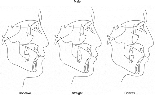 Figure 5. The predicted aesthetically facial profiles for males in the concave, straight, and convex groups.