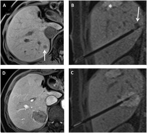 Figure 1. Example of ablation procedure in 1.5 T MRI system. Native T1 weighted planning imaging (A) in a patient after left hemihepatectomy and condition after thermal ablation with new colorectal liver metastasis in segment 7 (arrow). (B) Shows the control imaging angulated onto the applicator to determine the position of the applicator at the tumor lesion (arrow). The asterisk marks an old ablation zone. After thermal ablation (C), T1 weighted images were performed again to assess ablation zone size. Finally, contrast-enhanced images were taken (D) to detect bleeding complications and to evaluate potential tumor residuals.