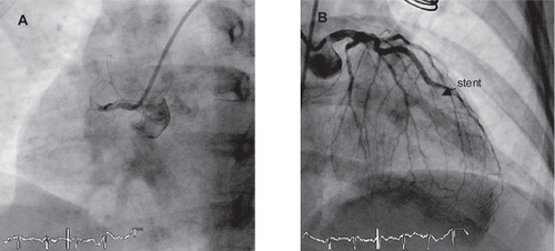 Figure 1 Angiographic images of stent thrombosis on RCA (A) and LAD (B).