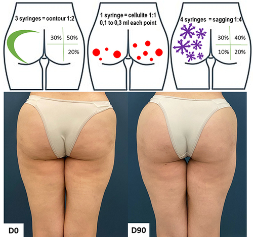 Figure 1 Case 1, Buttocks Beautification 3D. Schematic representation of the injections (above). Standardized posterior images pre and 90 days post injection (below). Each syringe = 1.5 mL of CaHA.