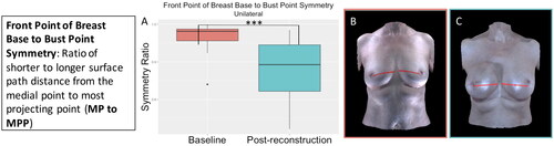 Figure 7. The front point of breast base to bust point symmetry significantly decreased (became more asymmetrical) for the participants who underwent unilateral implant-based reconstruction (p < 0.001). (A) Boxplot of symmetry at baseline and post-reconstruction (median and interquartile range). (B) The front point of breast base to bust point measurement on an exemplar patient. (C) The front point of breast base to bust point measurement on the same patient post-reconstruction.