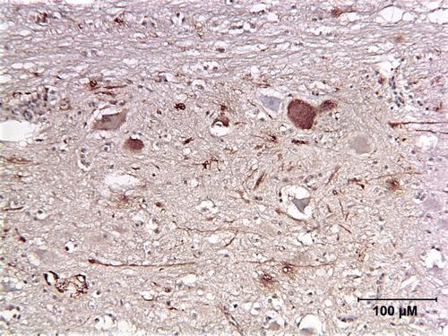 Figure 4.  Immunoperoxidase stained spinal cord of a blue and gold macaw (Case 0473) showing the presence of ABV N-protein in neurons and axonal staining within the grey matter.