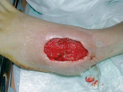 Figure 12. Wound after 5 days of VAC therapy.