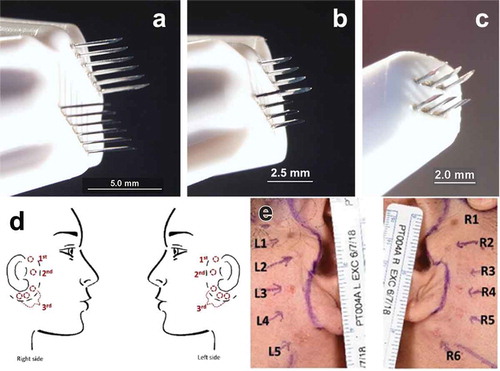 Figure 1. Three applicator tips used in this study along with treatment sites used. (a) 5 × 5 mm tip; (b) 2.5 × 2.5 mm tip; (c) 1.5 × 1.5 mm tip; (d) treatment sites used in first cohort of three patients; (e) treatment sites used in second cohort