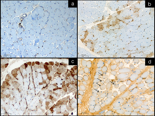 Figure 2 Representative immunohistochemical staining of MxA in muscle biopsies. Positive expression was defined by unequivocal sarcoplasmic staining in only intact fiber, not a regenerating or degenerated/necrotic fiber. (a) MxA negativity. (b) Moderate MxA positivity and perifascicular area pattern. (c) Strong MxA positivity and perifascicular area pattern (b and c in dermatomyositis patients). (d) Weak MxA positivity and non-perifascicular area pattern, positive fibers labeled with black arrow (in overlap myositis patient).