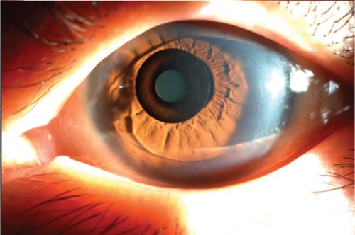 Figure 1 The phakic intraocular lens eye with implanted KAMRA inlay.