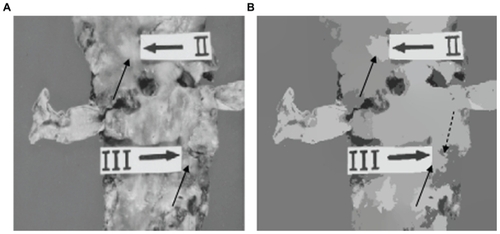 Figure 2 (A) Original image and (B) segmentation using our unsupervised strategy. The arrows indicate isolated lesions. The split arrow indicates a zone which is not a lesion.