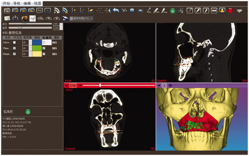 Figure 4. The reposition of the loosed maxilla under the interactive guidance of 2D and 3D image rendering environment. The red and green contours in the 2D views respectively represent the positions of the intraoperative tracked and the preoperative planned loosed maxilla. The red and green models in the 3D view, respectively, represent the intraoperative tracked and the preoperative planned loosed maxilla.