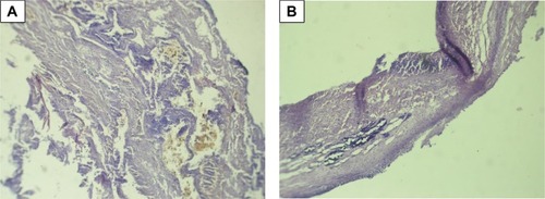 Figure 6 Micro-samples of bioprosthetic leaflet with endocarditis, stained with hematoxylin-eosin. Leuko-, lymphocytic infiltrates are visualized. Original magnification ×100. The two panels (A and B) show the morphology of calcification.