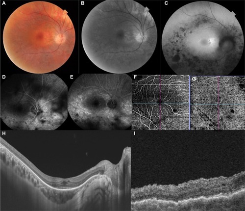 Figure 1 Multimodal images of the right eye.