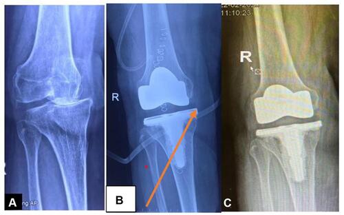 Figure 3 X-ray images before and after PL release. (A) Preoperative X-Ray image showing medial translation. (B) Post operative X-ray image without PL release-showing persistent subluxation. (C) Post operative X-ray image After PL release with restoration of alignment.