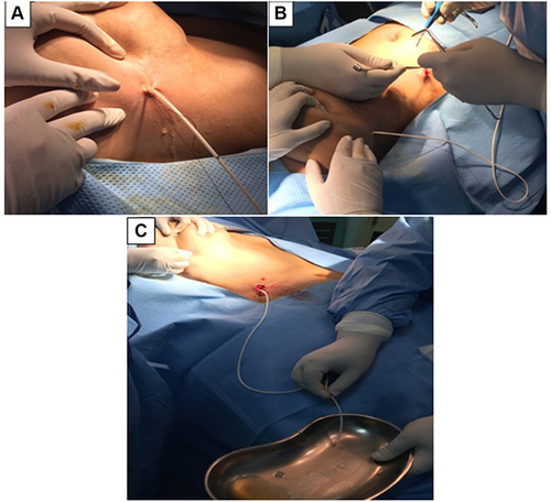 Figure 4 (A) Inframammary fold incision for the catheter insertion in the right breast. (B) The right lumber region incision for the catheter insertion. (C) The fluid is freely draining from the breast tissue before insertion into peritoneal cavity.