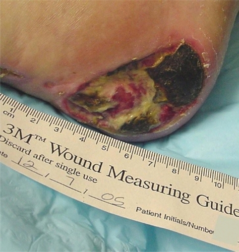 Figure 10 Right posterior heel, Stage IV, with slough and eschar.