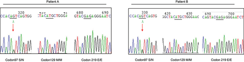 Figure 1. Graphic presentation of the sequencing analysis of PRNP. DNA sequences from the two patients at codon 97, codon 129 and codon 219. Heterozygous transition at codon 97 from ser (S) to asp (N) in one PRNP allele (left graph), homozygous methionine (M) at codon 129 (middle graph) and homozygous glutamic acid (E) at codon 219 (right graph). Arrow indicates the heterozygote of S97N.