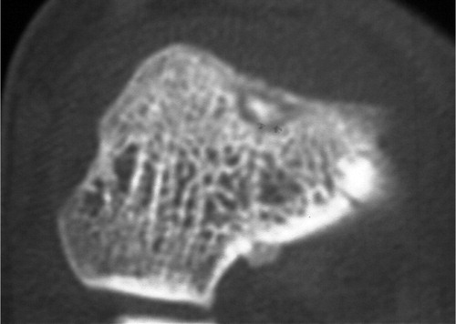 Figure 2. Case 1. CT showing an osteoid osteoma in the anterior aspect of the talus.