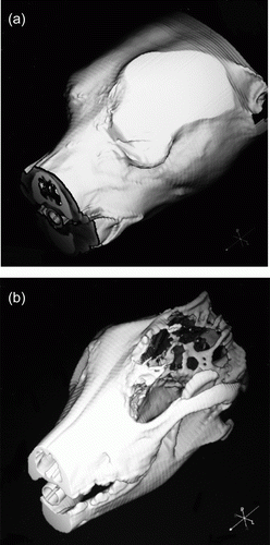 Figure 2.  Three-dimensional reconstructed CT image of the skull. (a) Lateral reconstruction of the head where a mass formation occupying the orbital fossa is visualised. (b) 3D image with extraorbital involvement and focused on frontal and parietal areas, showing bone lysis and invasion into the cranial cavity.