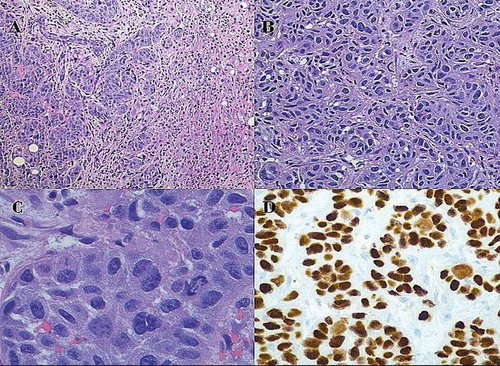 Figure 2. Histochemical findings of metastatic lesions of the liver: (a) low power view (H and E stain, original magnification of 100X) of showing tumor clusters on the left and hepatic tissue on the right with no evidence of glandular differentiation (b) high power view (H and E stain, original magnification of 400x) showing nests of tumor cells. (c) very high-power view (H and E stain, original magnification of 600x) showing tumor cells with intercellular bridges (a sign of squamous differentiation), variably sized hyperchromatic nuclei and small nucleoli. (d) high power view (Immunohistochemical staining, original magnification of 400x) showing positive nuclear staining with p40 showing squamous differentiation.