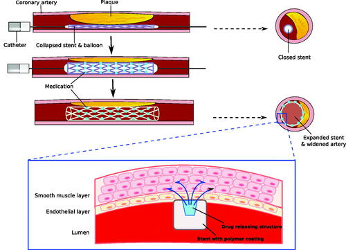Figure 2. Drug-eluting and biodegradable stent in coronary artery. Drug-eluting and biodegradable stents maximize the effectiveness of stent in atherosclerosis while minimizing side effects. These stents allow specific drug delivery into endothelial and smooth muscle cells in the affected area, and decrease chances of inflammatory process and restenosis. Stents are covered by polymer coating, which can be degraded gradually as drug delivery is completed.