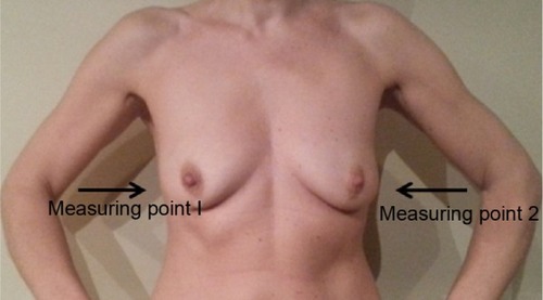 Figure 5 Ultrasound measuring points before mastectomy (measurement I).