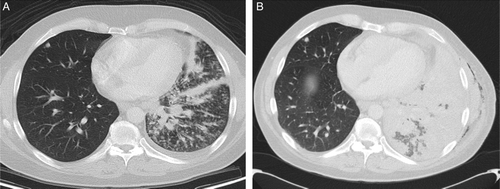 Figure 2.  Patient 2. A. Pulmonary and lymph node metastases with pleural effusion. B. Increase lymphangitis carcinomatosis after discontinuation of sorafenib.