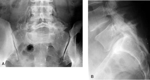 Figure 9:1 Posterolateral fusion after decortication and deposition of BMP-7. No bone grafting performed. A. Anteroposterior view. B. Lateral view.
