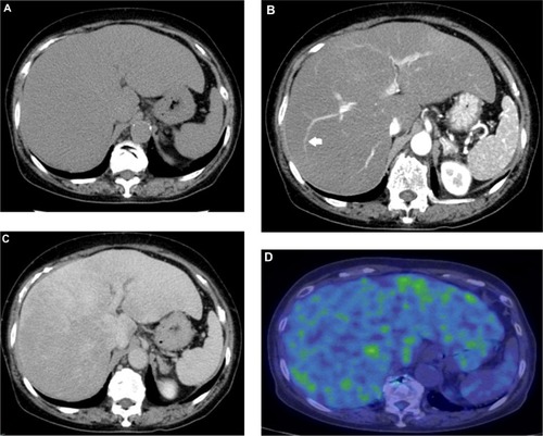 Figure 1 Contrast-enhanced CT revealed hepatomegaly and heterogeneity of contrast staining.