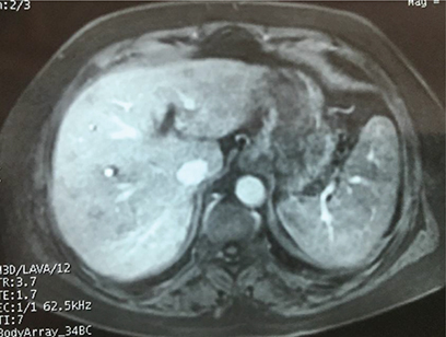 Figure 2. Contrast enhanced T1-weighted sequence on MRI showing very week enhancement.