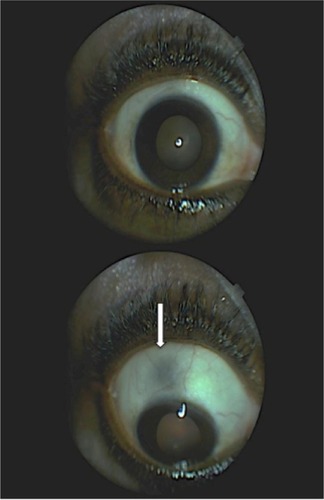 Figure 4 Right eye 8 months after initiating the treatment with sulfasalazine.
